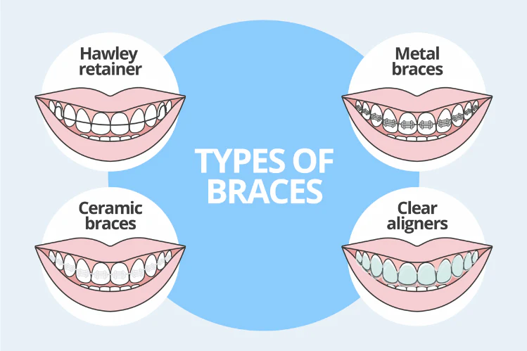 Illustration of various types of braces